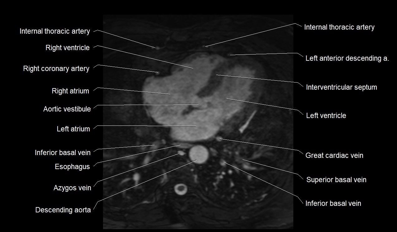 MRI heart coronary arteries and coronary veins anatomy axial image 29.jpg